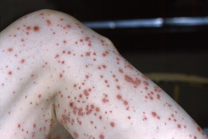 Varicella (Chickenpox) Effects
