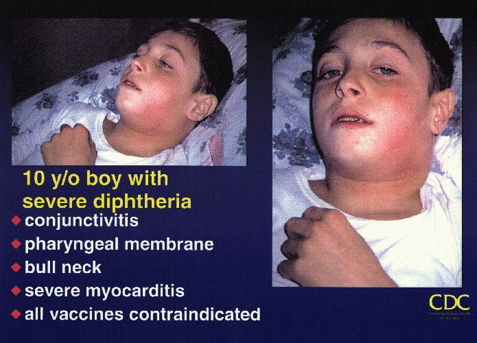 Diphtheria Effects