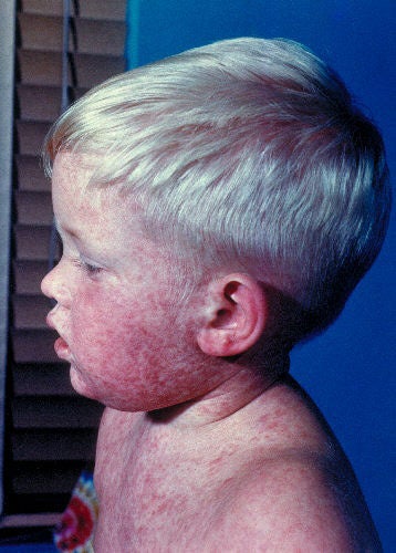 Measles Effects