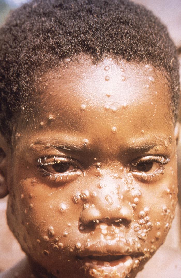 Mpox Effects