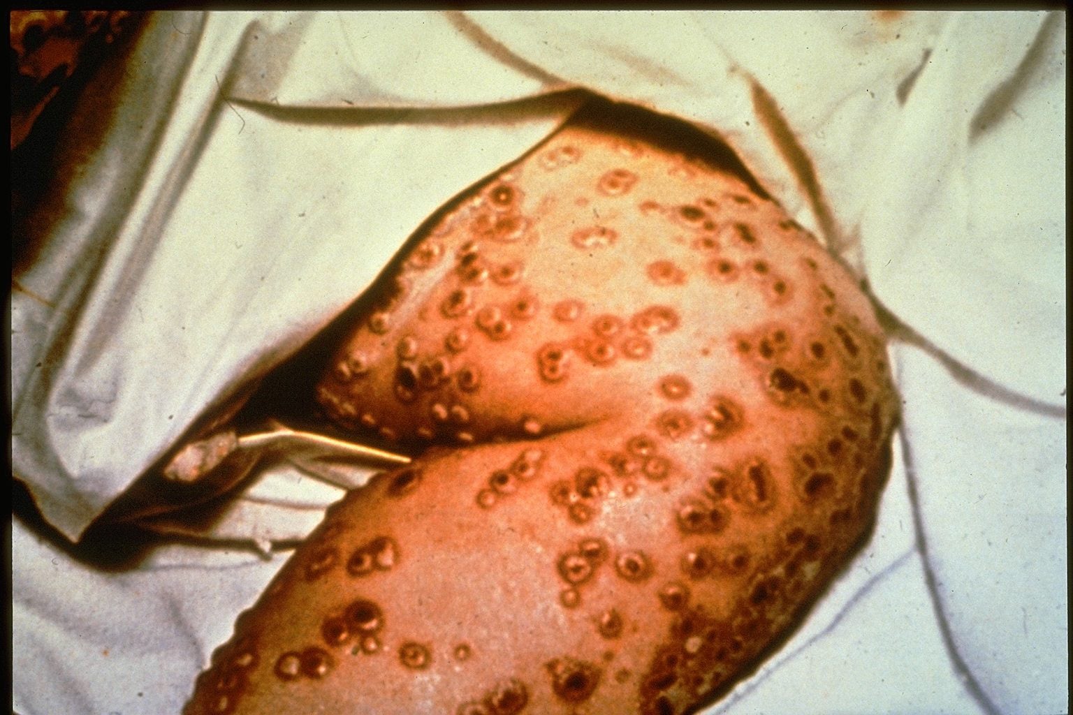Smallpox Effects